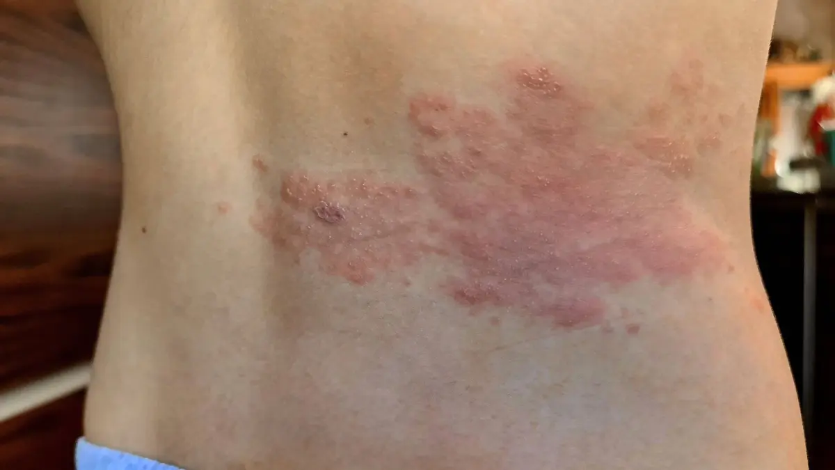 Guertelrose am Ruecken shingles rash on the rear BLWS659352 *** Shingles rash on the rear BLWS659352 Copyright: xblickwinkel/fotototox