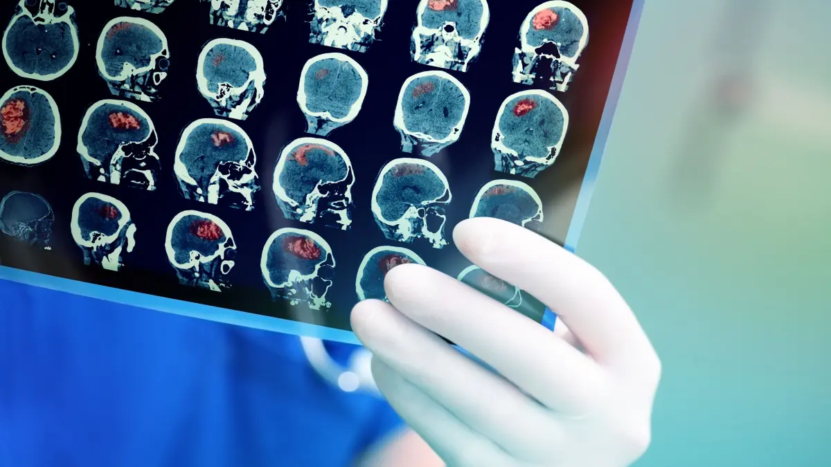 Je nach betroffenem Hirnareal sind die Folgen eines Schlaganfalls unterschiedlich stark. In den Sana Kliniken Niederlausitz erhalten Betroffene in der zertifizierten Stroke Unit professionelle Hilfe.