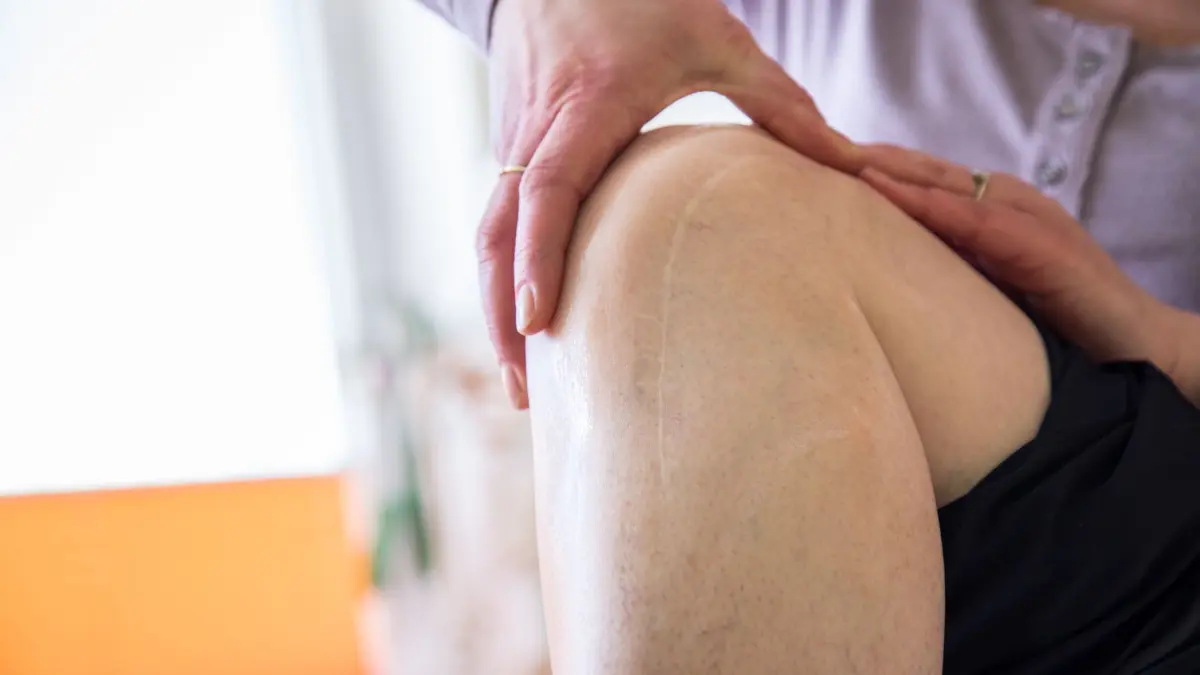 Eine Frau massiert eine Operationsnarbe am Knie: ILLUSTRATION - Es geht nicht nur ums Aussehen: Narben, die unschön verheilen, sind manchmal auch ein medizinisches Problem. (zu dpa: «Was hilft, wenn mich das Aussehen einer Narbe belastet?») Foto: Christin Klose/dpa-tmn - Honorarfrei nur für Bezieher des dpa-Themendienstes +++ dpa-Themendienst +++