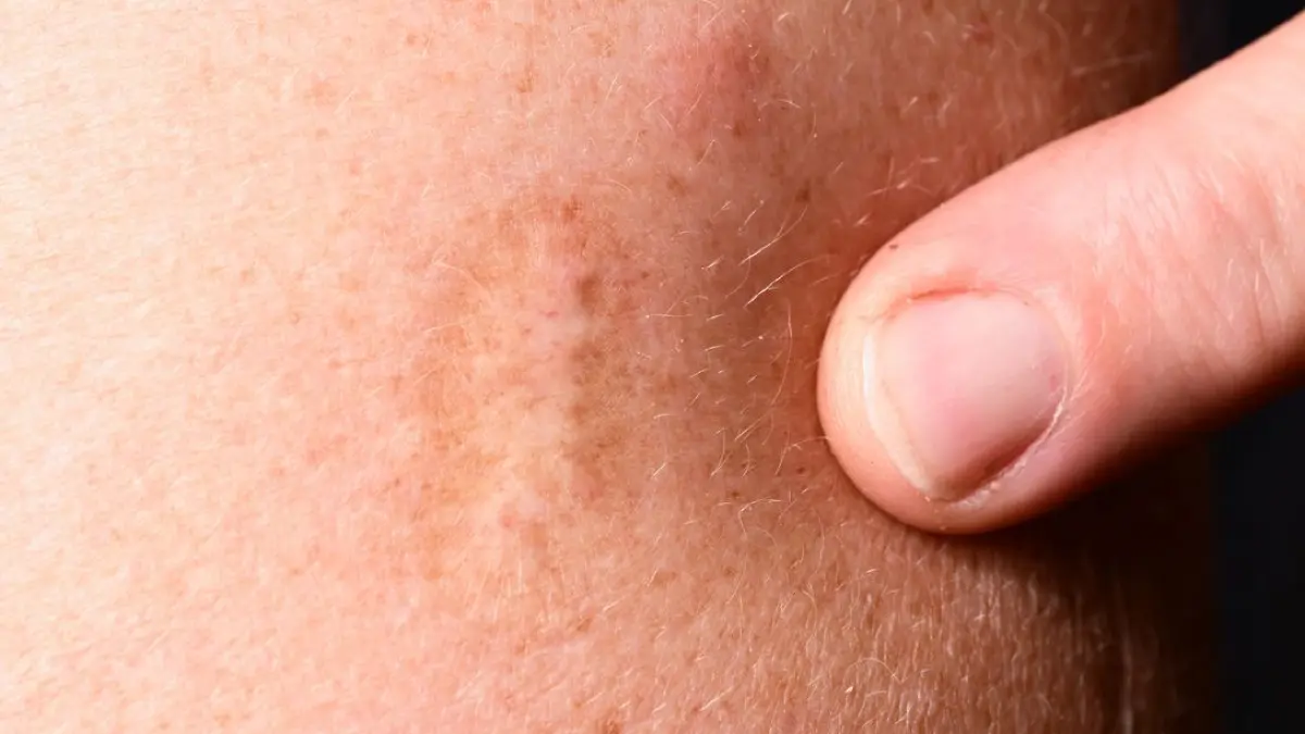 Eine Narbe einer Pockenimpfung ist an einem Oberarm sichtbar. Die Pocken zählten lange zu den gefährlichsten Krankheiten überhaupt für den Menschen. Impfstoffe brachten die Rettung, seit 1980 gilt die Welt als pockenfrei.